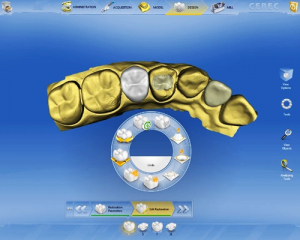 one-day porcelain dental crowns with new CEREC CAD/CAM