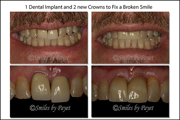 A dental implant and dental crowns for cosmetic dentistry by Charlotte dentist Dr. Payet