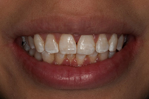 chipped-front-tooth-after After photo of a smile with composite bonding to fix a broken tooth