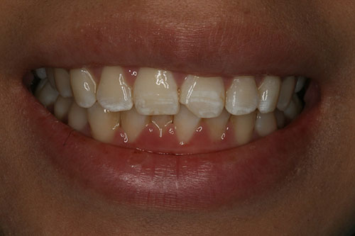 chipped-front-tooth-before A chipped front tooth can be fixed conservatively and affordably with bonding.