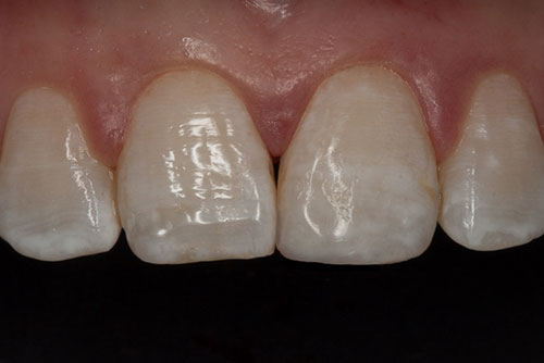 front-tooth-bonding Close-up photo of a tooth-colored composite filling, or bonding