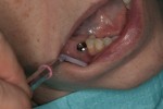 Teeth are very small to work on with no magnification
