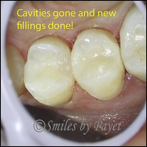 Tooth colored fillings look natural and are very strong