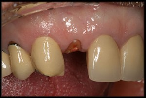 A broken tooth is a problem - call your Charlotte NC dentist right away.