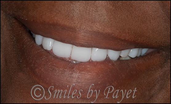 Beautiful dentures natural smile dentist Charlotte, Lake Norman, Matthews, Pineville, Rock Hill