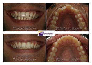 Six Month Braces before-after by dentist Charlotte, Matthews, Pineville, Rock Hill
