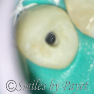 Charlotte NC dentist uses a dental microscope for root canals