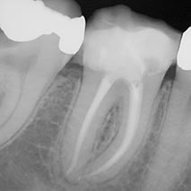 Charlotte NC dentist uses digital x-rays for root canals, toothaches.
