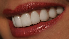 Smile Makeover after-photo of patient who had 20 porcelain veneers by Charlotte dentist Dr. Charles Payet