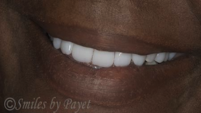 Denture patient's smile