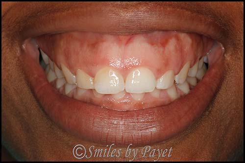 Gummy smile before laser cosmetic dentistry charlotte nc