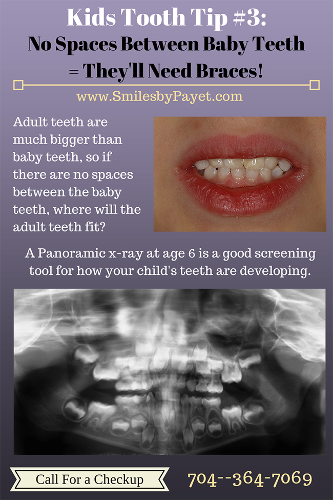 Kids Tooth Tips from Charlotte dentist Dr. Payet; space between baby teeth is good