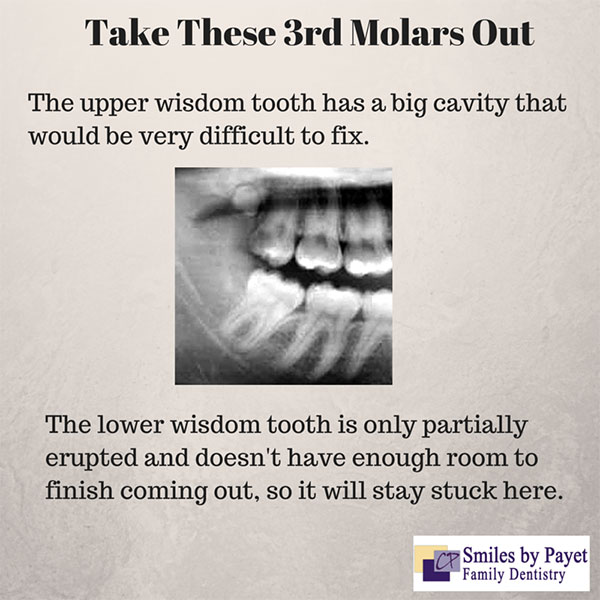Reasons wisdom teeth need to be extracted