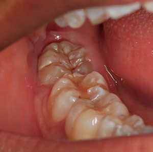 partially erupted wisdom tooth