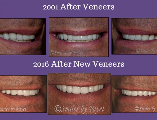 Replacing Veneers after 15 Years