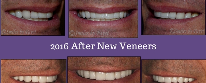 10 porcelain veneers; cosmetic dentist Charlotte NC