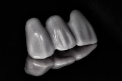 A CEREC E.max bridge made by Charlotte dentist Dr. Charles Payet
